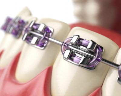Aparat ortodontyczny - wszystko co musisz wiedzieć przed założeniem