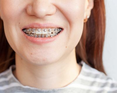 Krzywe zęby - jakie są przyczyny? Jak możemy leczyć?