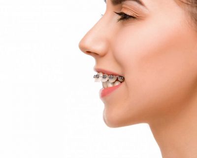 Wyciągi ortodontyczne - czym są, dlaczego są stosowane?