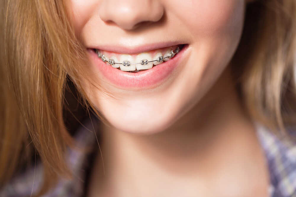 aparat metalowy na zęby u kobiety piękny uśmiech
