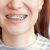 Krzywe zęby – jakie są przyczyny? Jak możemy leczyć?