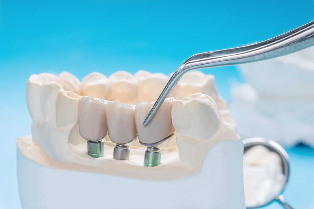 most zębowy na implantach