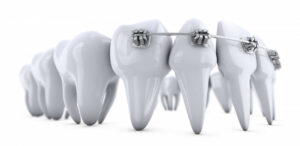 aparat ortodontyczny na zębach