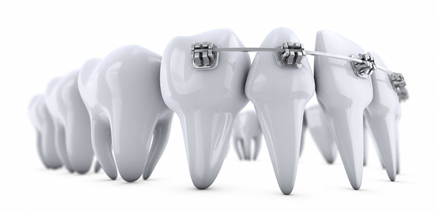 aparat ortodontyczny na zębach