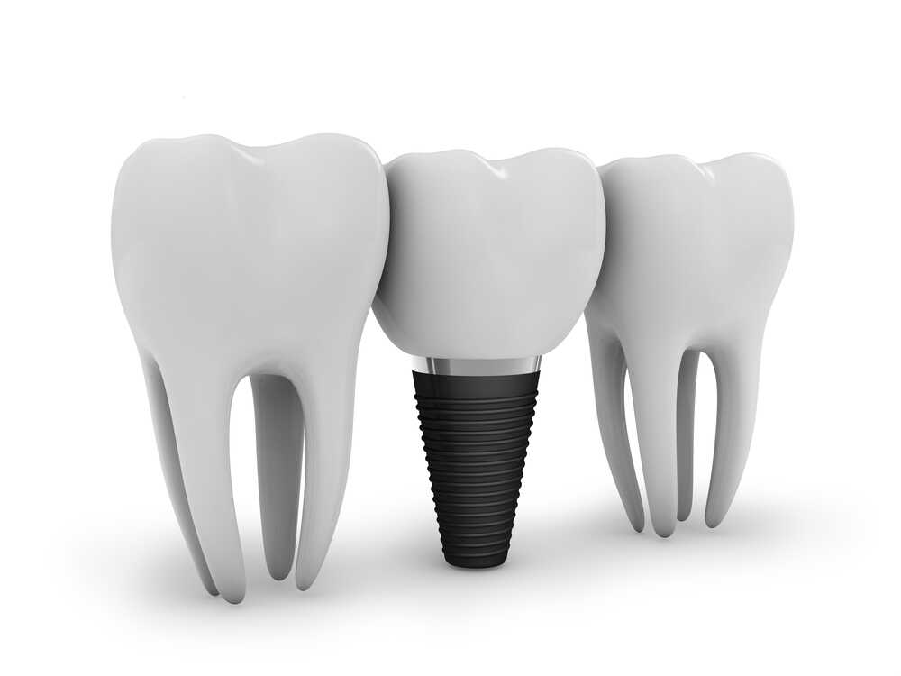 implanty zębów przedstawiony model