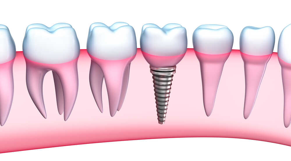 Ilustracja prezentująca implanty zębowe