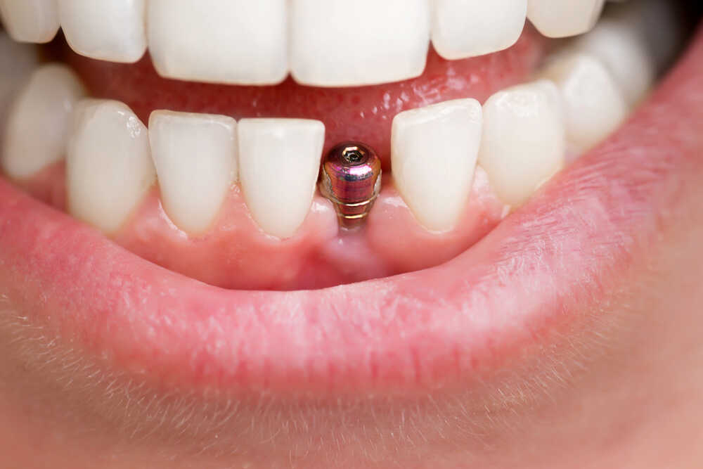 Implant zęba w dużym zbliżeniu osadzony w szczęce pacjenta