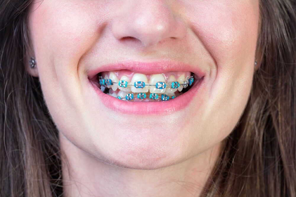 kobieta uśmiecha się i pokazuje kolorowe ligatury ortodontyczne na aparacie