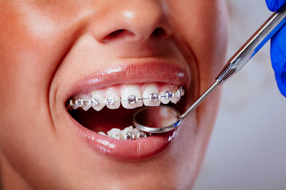 leczenie ortodontyczne aparatem metalowym