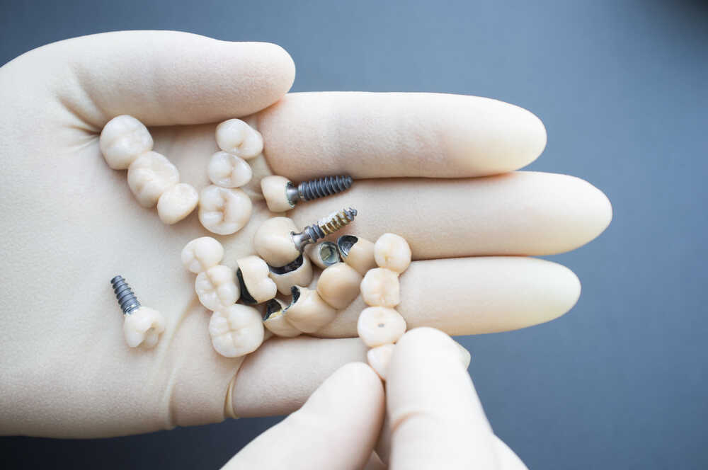 implanty zębowe w ręce stomatologa